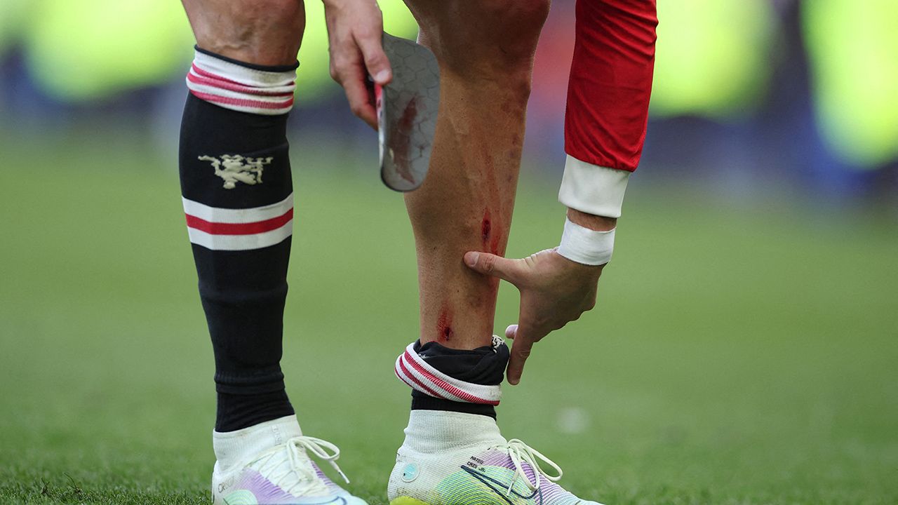 La herida que mostró que Cristiano Ronaldo no dejó de luchar